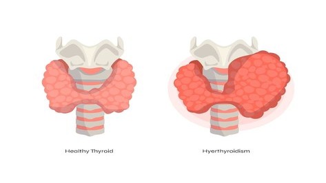 Thyroid disease - Type, Risk, Symptoms And Diagnostic Tests